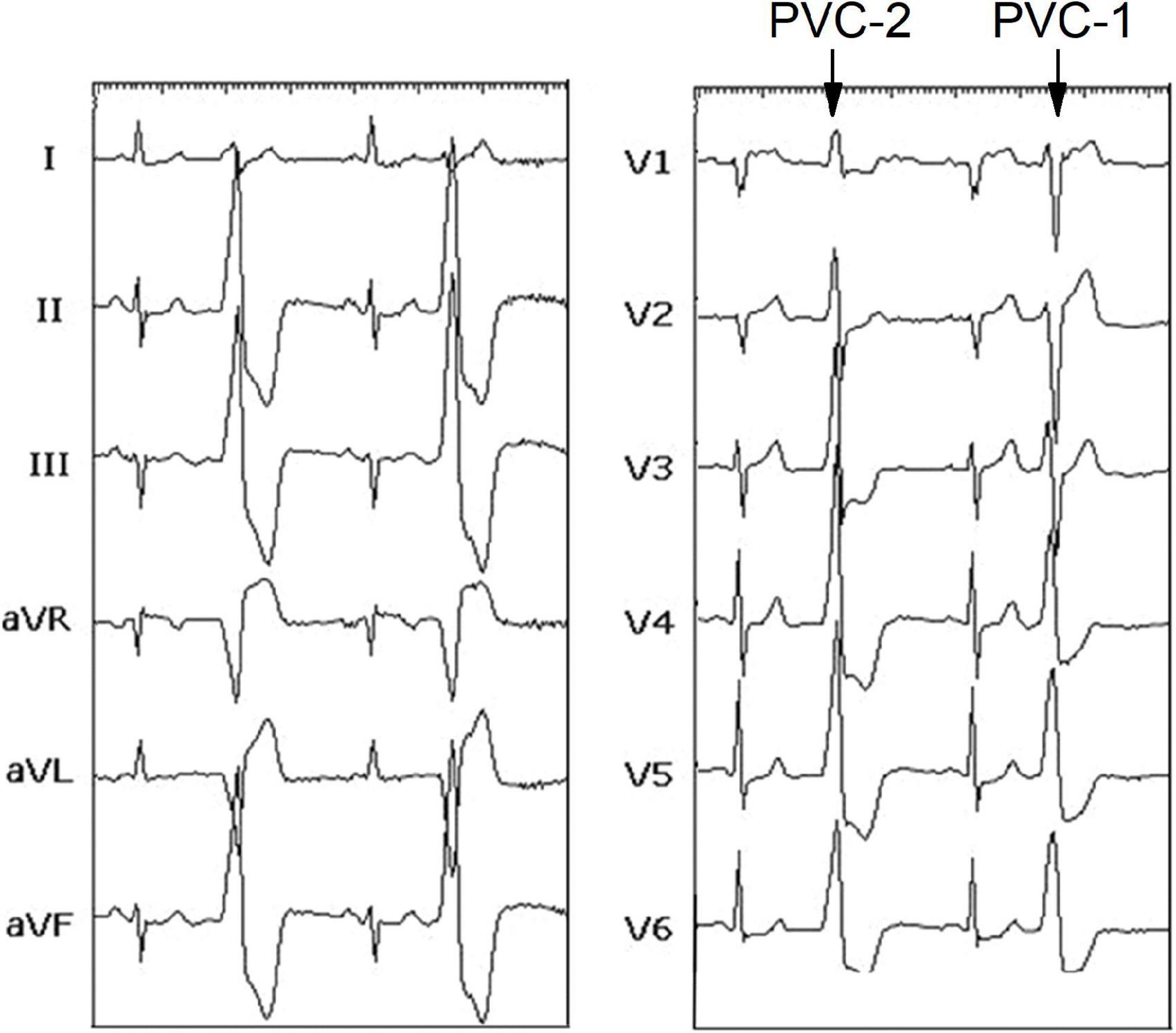 Successful ablation of morphology-changing premature ventricular contractions under the guidance of local voltage potentials: A case report